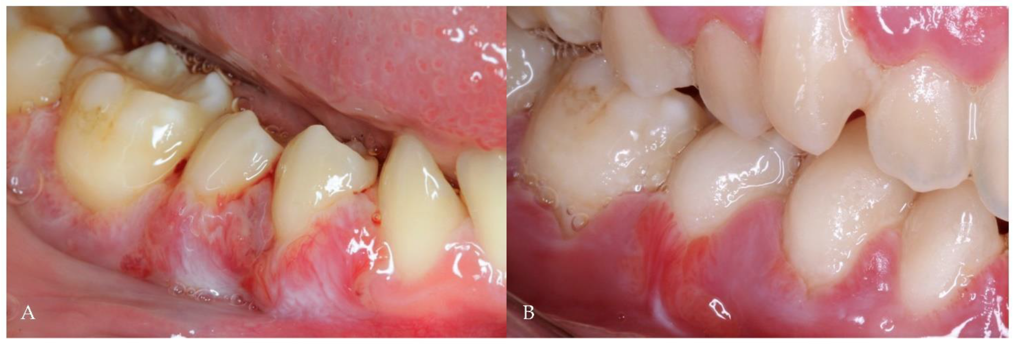 Antibiotics Free FullText Analysis of the Oral Microbiome in a