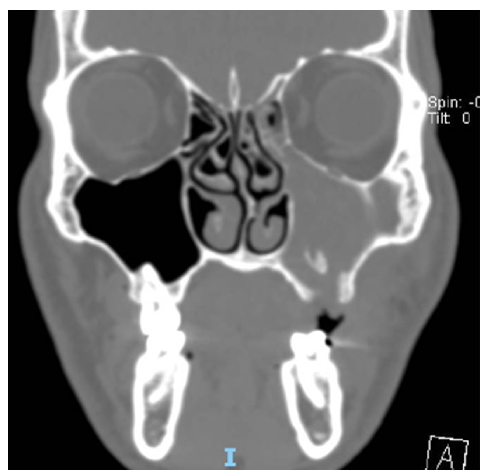 Antibiotics Free FullText Odontogenic Sinusitis from Classical