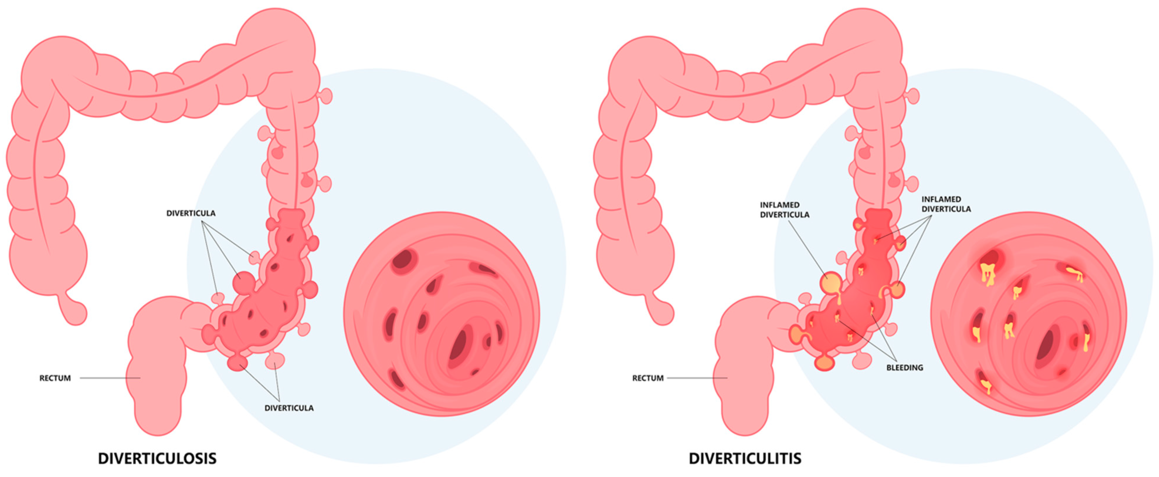 Antibiotics Free Full Text Diverticular Disease and Rifaximin: An Antibiotics Free Full Text Diverticular Disease and Rifaximin: An