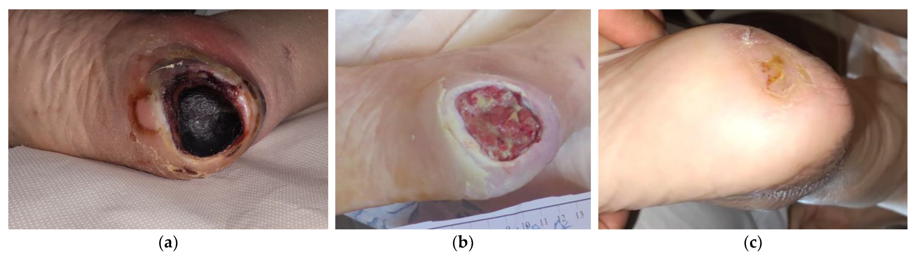 Bedsores (Pressure Ulcers) Condition, Treatments and Pictures for