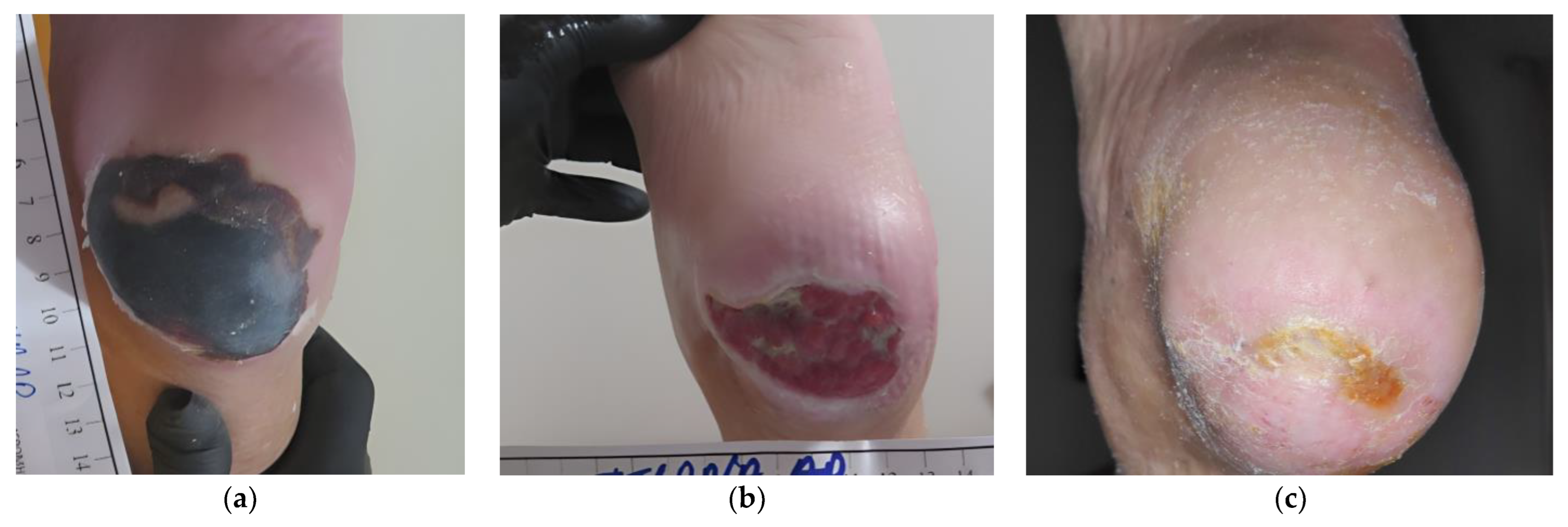 Pressure sore shop on heel treatment