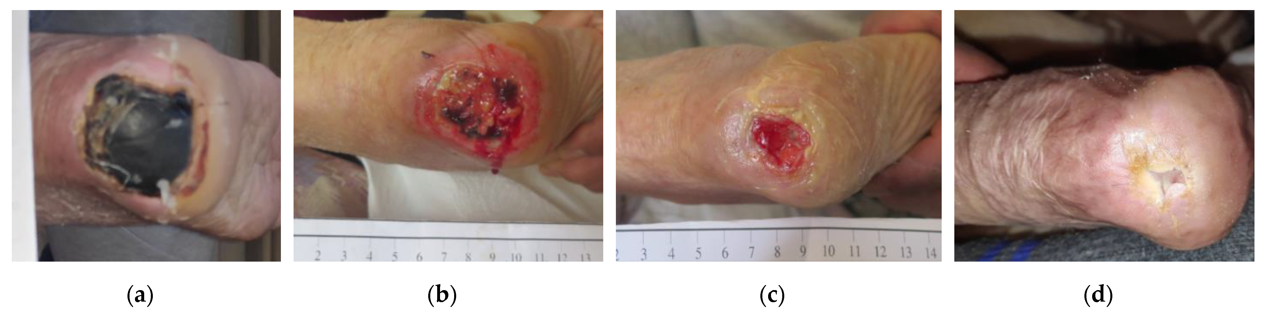 Heel pressure sore sales
