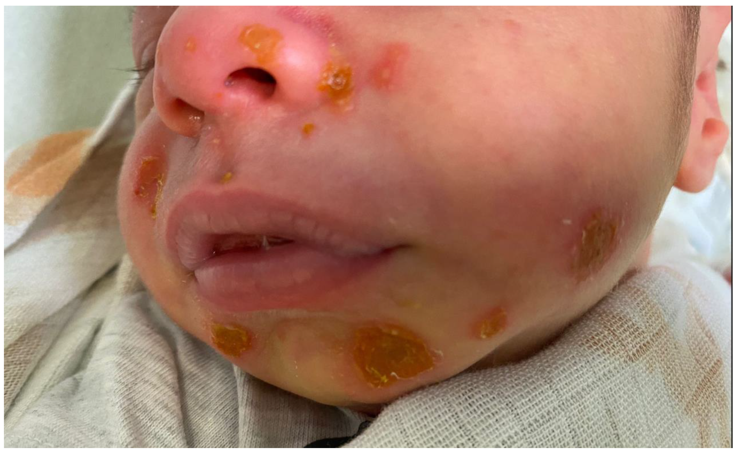 bullous impetigo in children