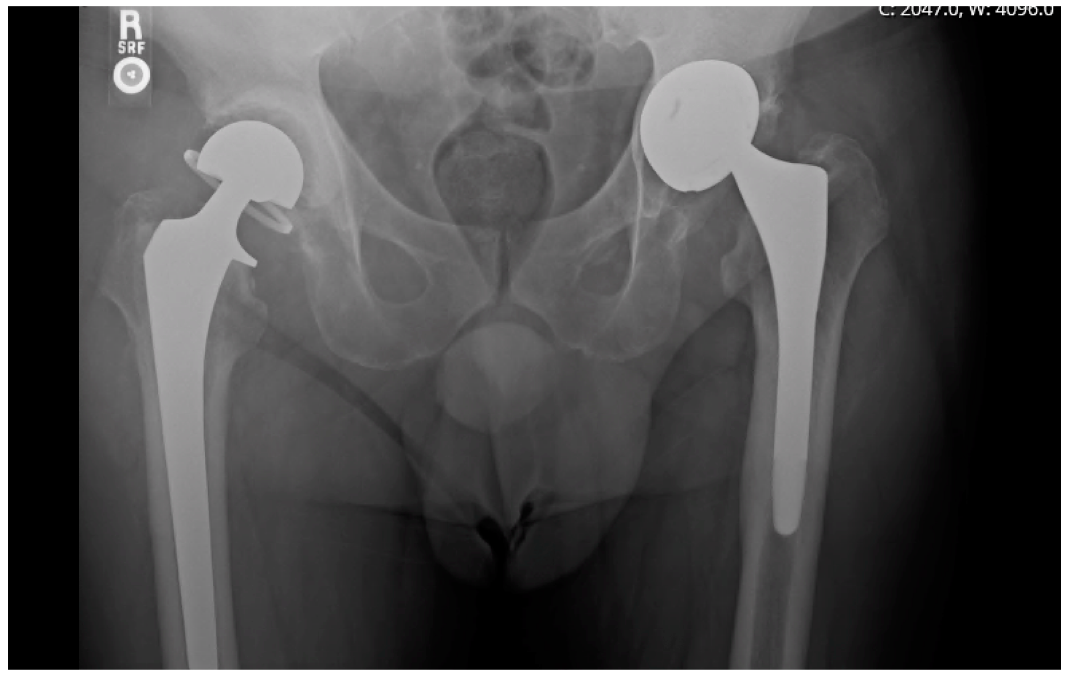 Antibiotics Free FullText Articulating Hip Spacers with a