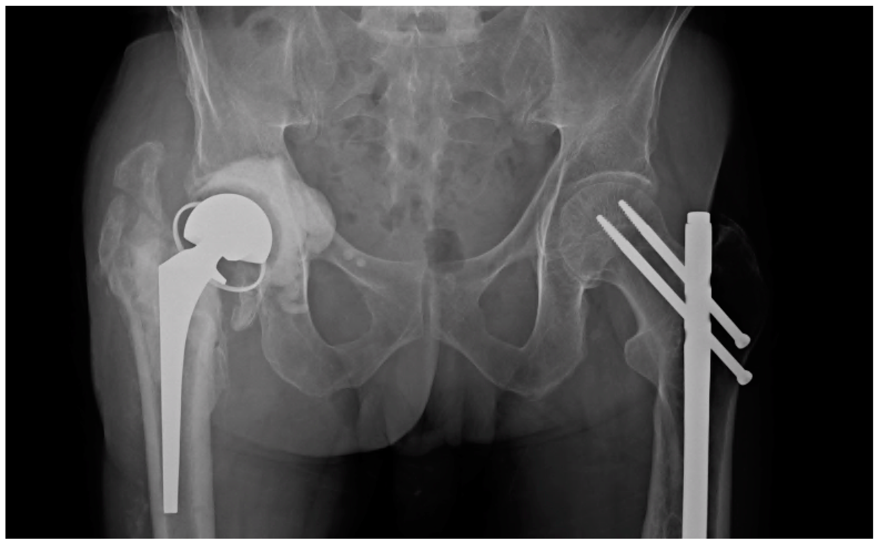 Antibiotics Free FullText Articulating Hip Spacers with a