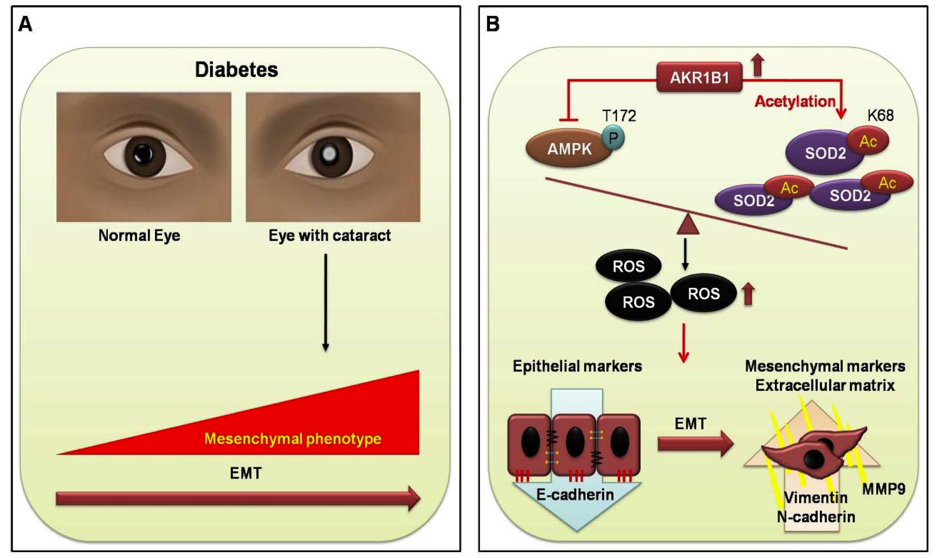 cataract diabetes mellitus 2-kezelés