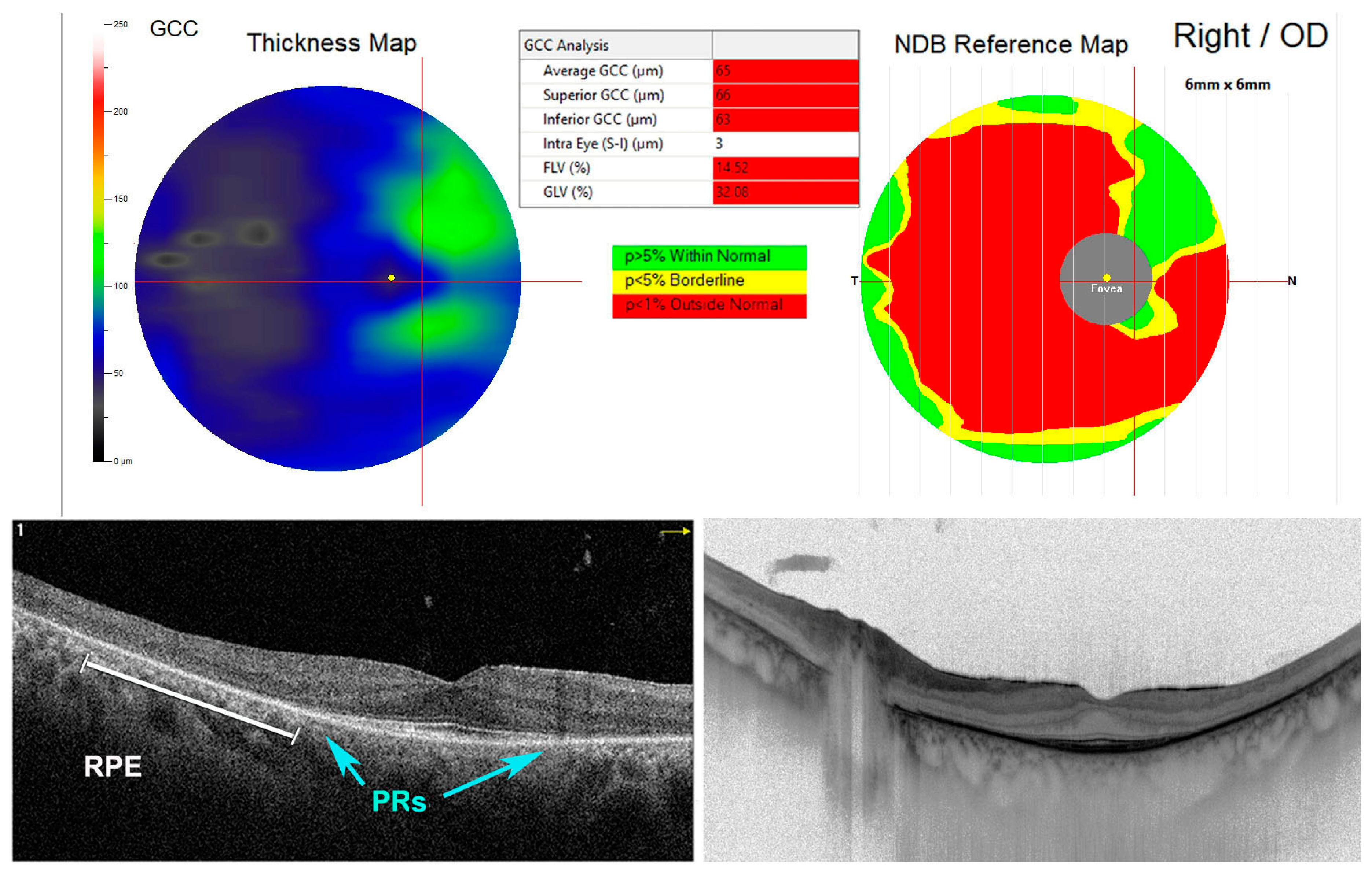 Oxidative Stress Implication in Retinal Diseases—A Review