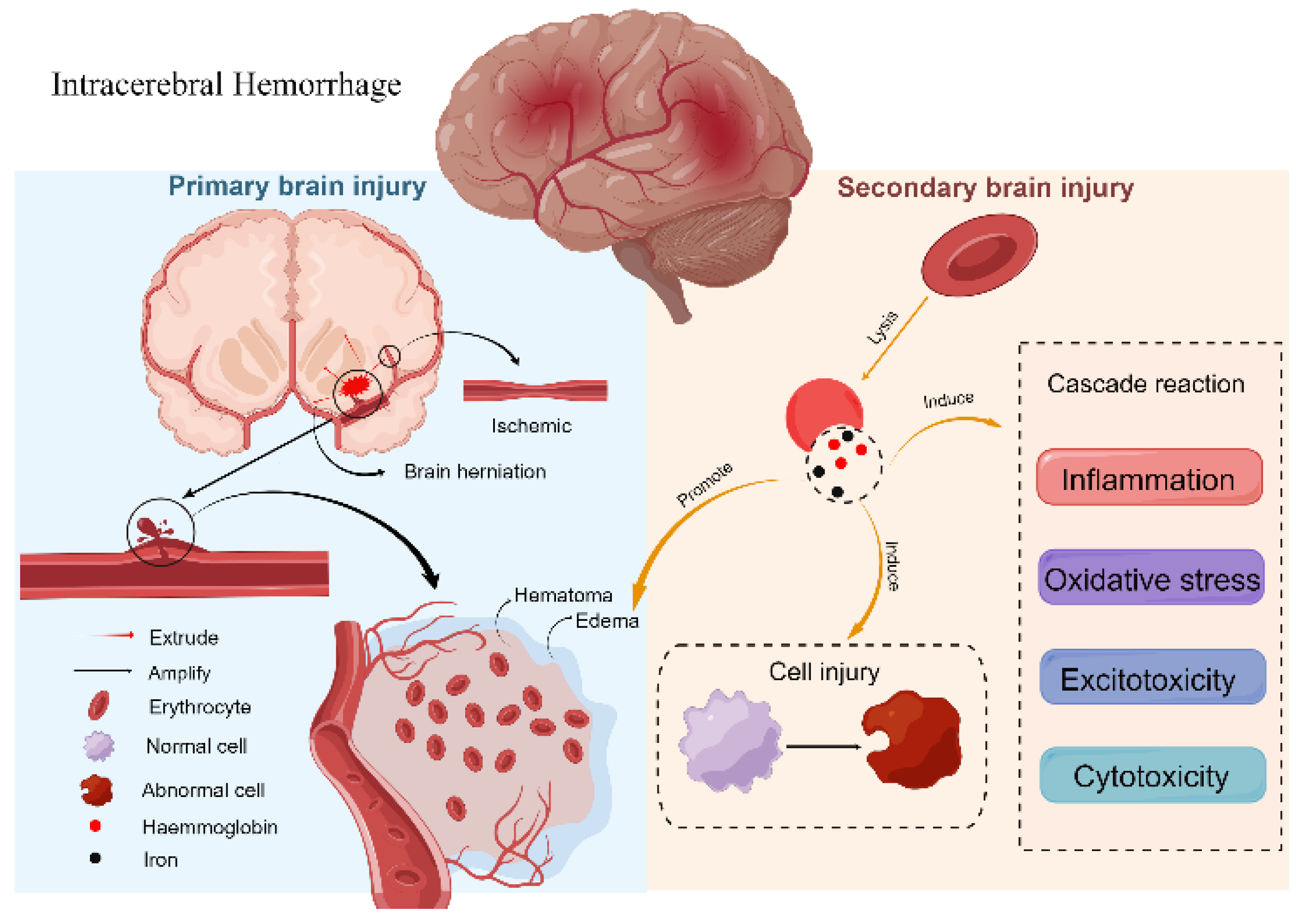 Intracranial Hemorrhage Grading