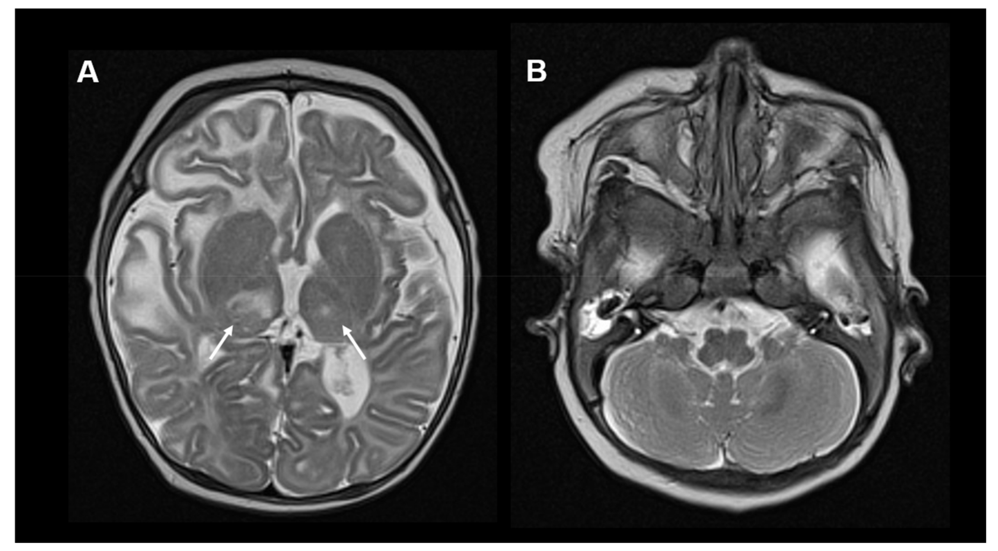 Neuroimaging in Primary Coenzyme-Q10-Deficiency Disorders