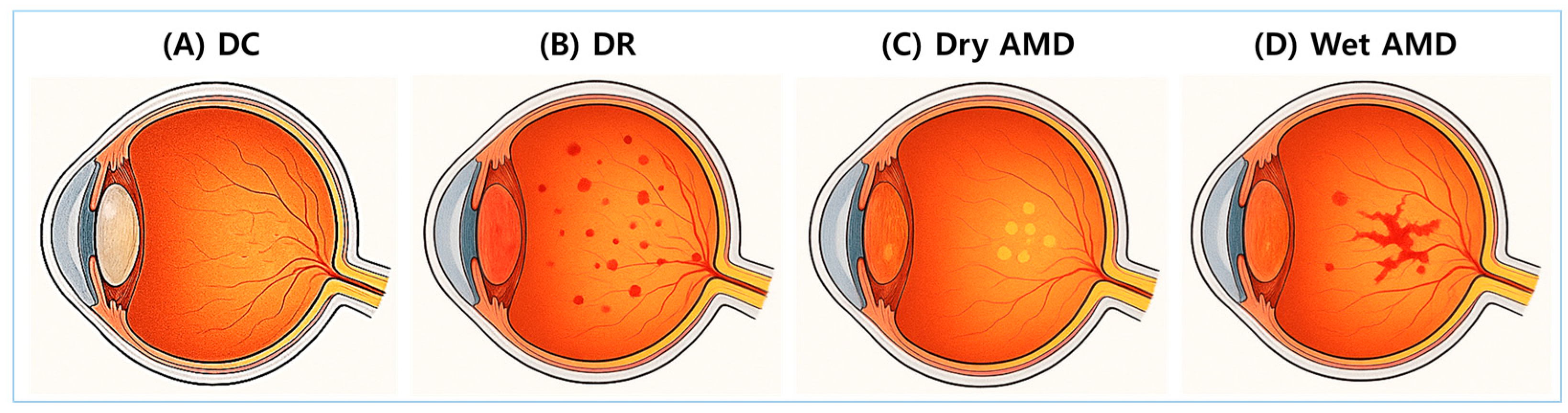 Restoring Glutathione Homeostasis in Glycation-Related Eye