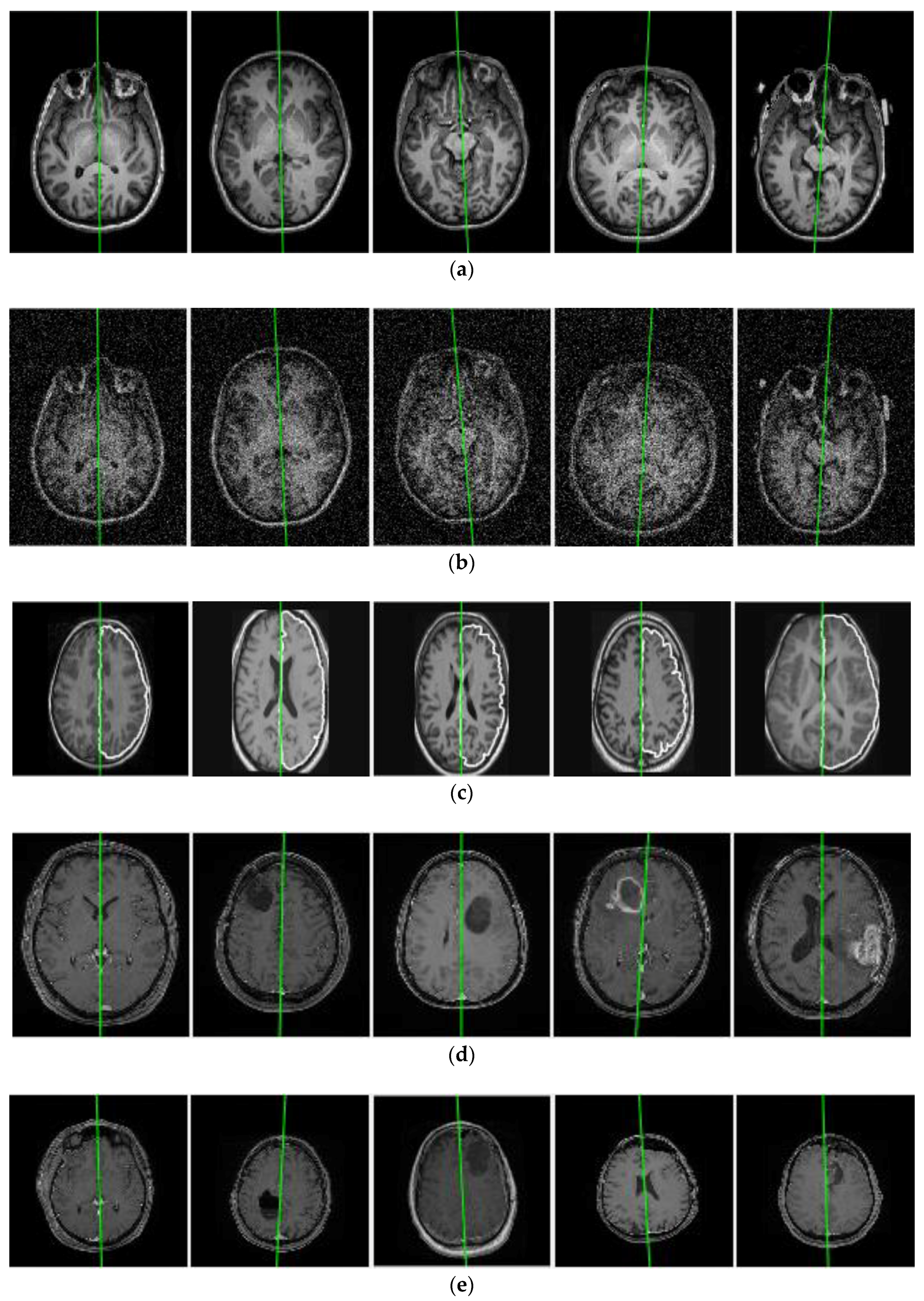 An Efficient Automatic Midsagittal Plane Extraction in Brain MRI