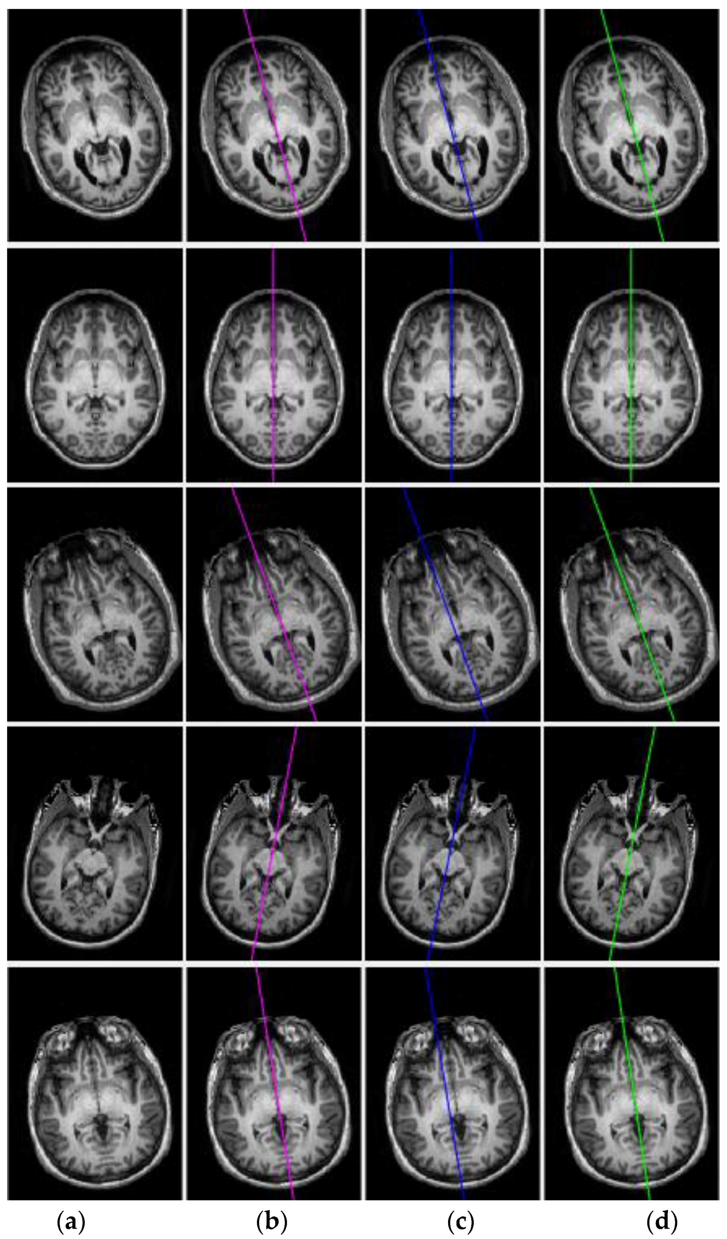 An Efficient Automatic Midsagittal Plane Extraction in Brain MRI