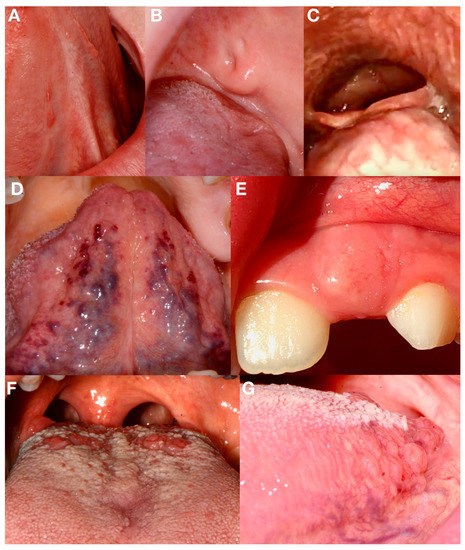 lingual tonsil cancer symptoms