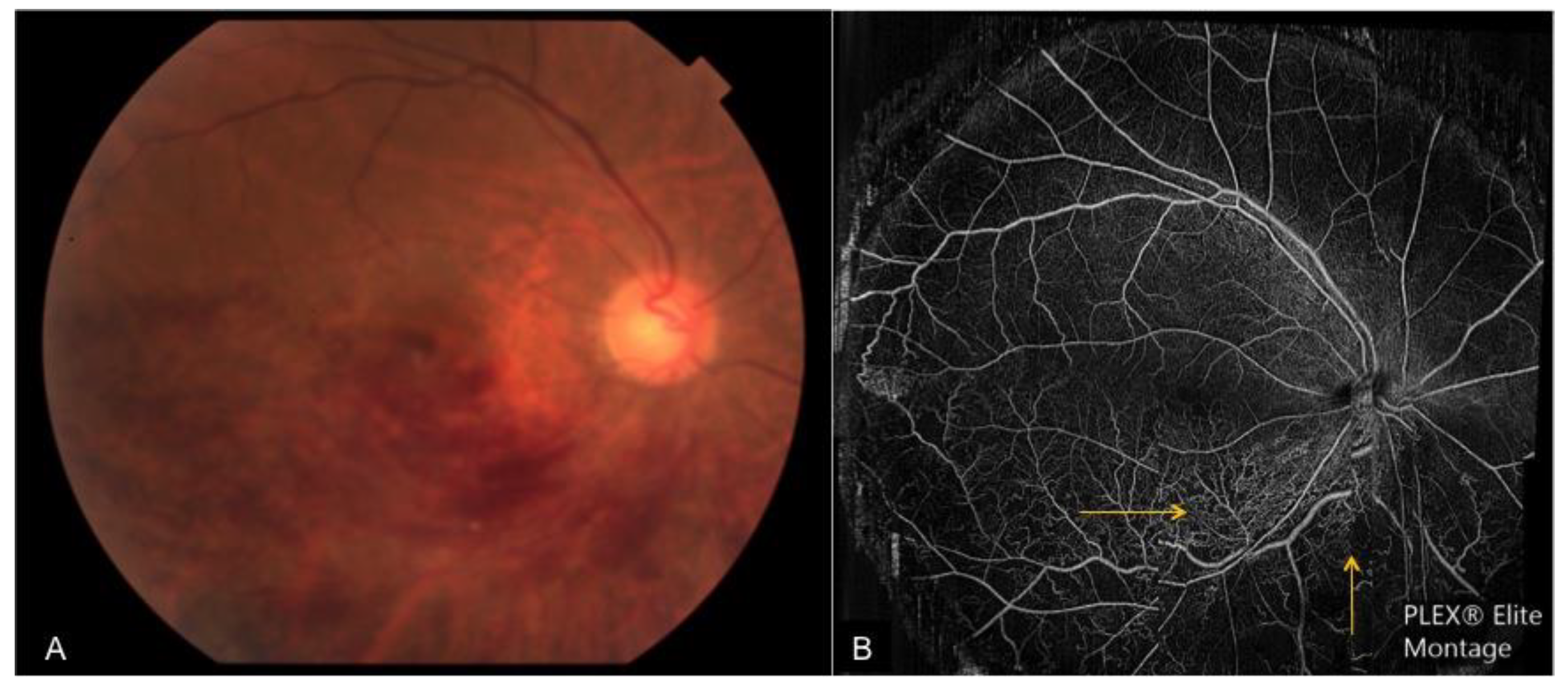 dot blot hemorrhages dot blot hemorrhages