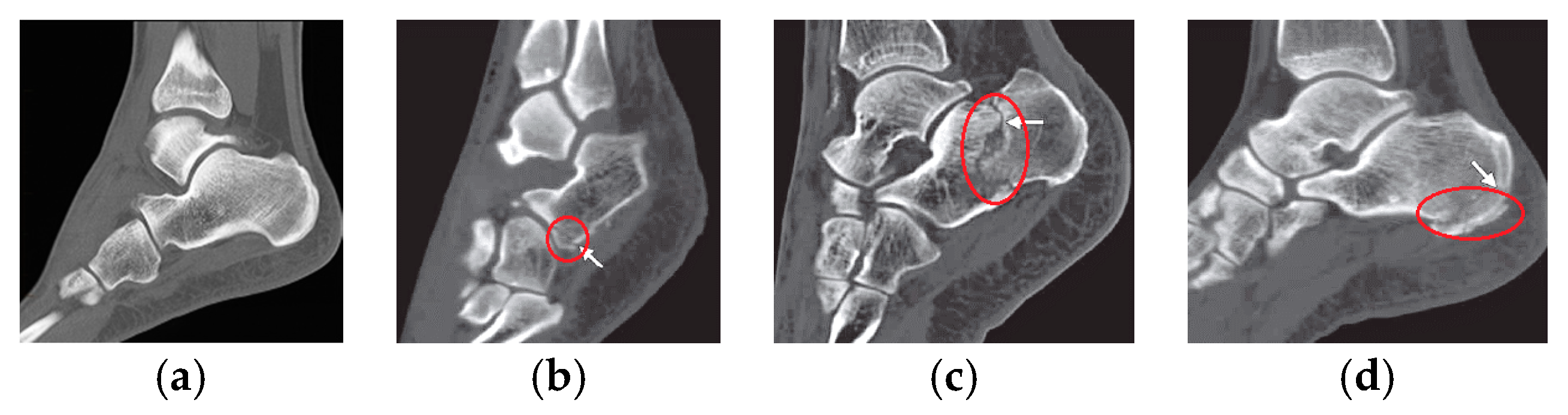 Calcaneus Fracture Classification