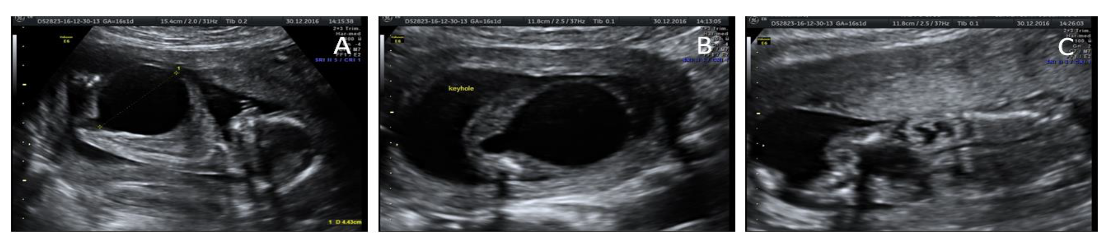 Keyhole Sign In Posterior Urethral Valve A Pictures Of Hole 2018