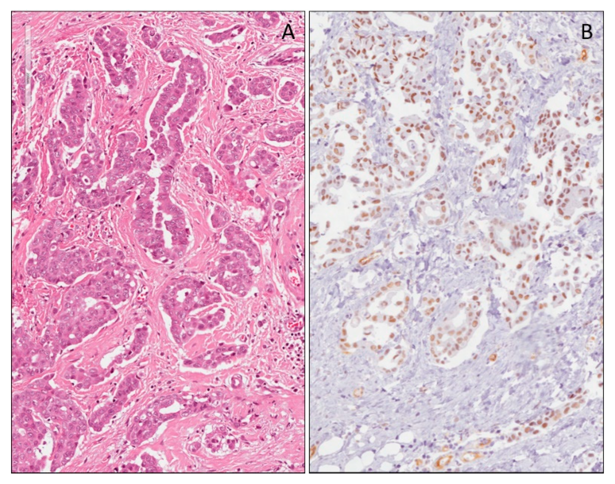 mesothelioma antibody panel