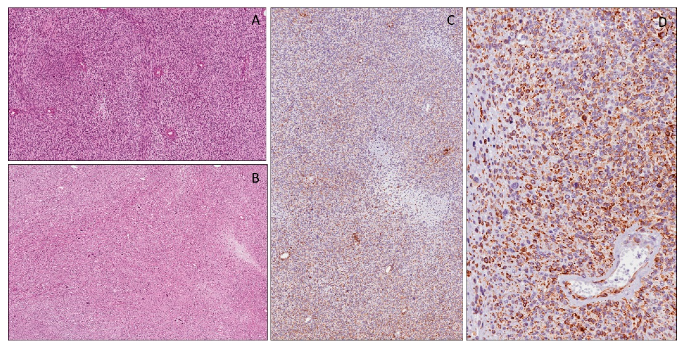 mesothelioma stages symptoms