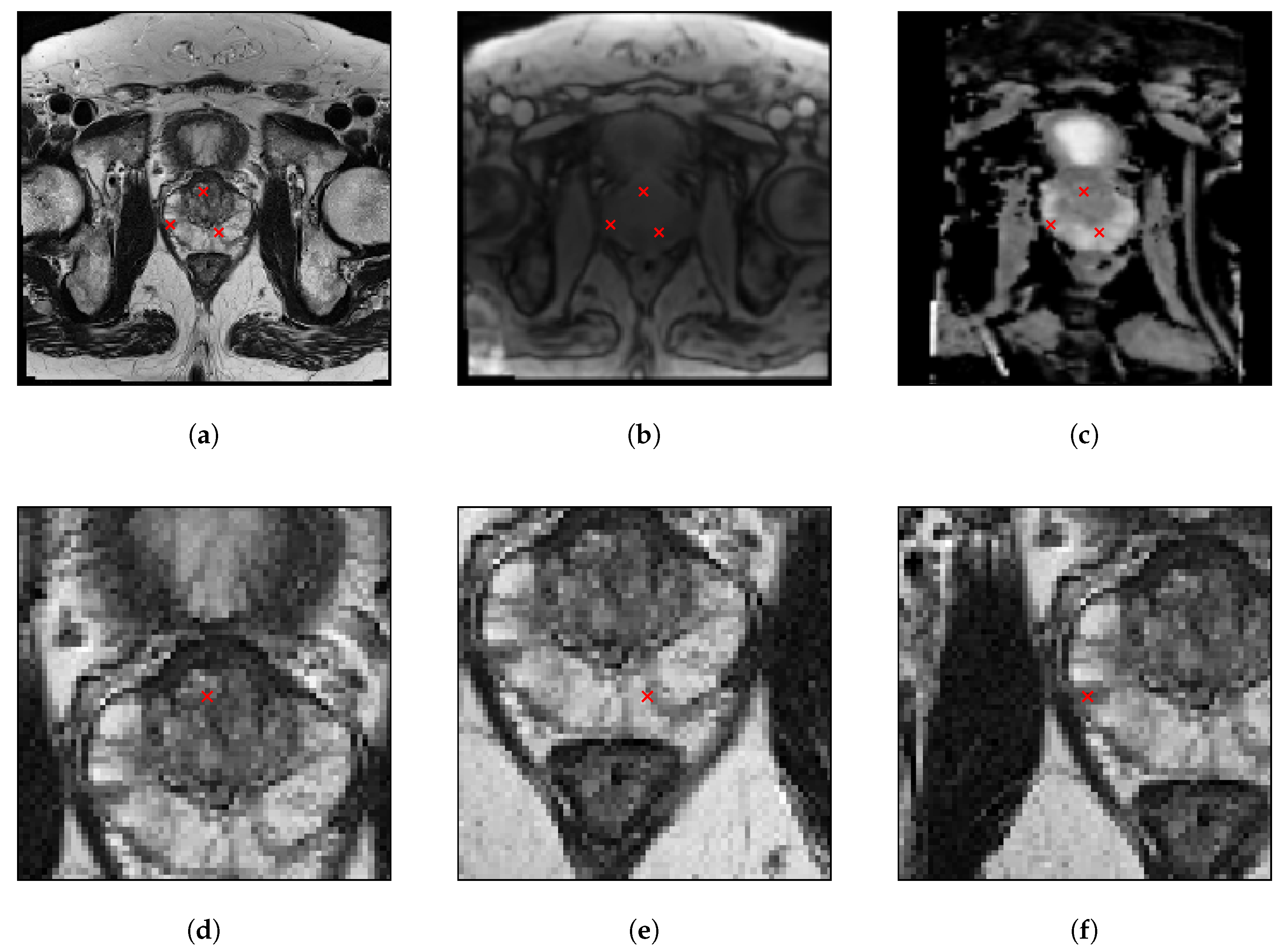 prostatitis és mri)