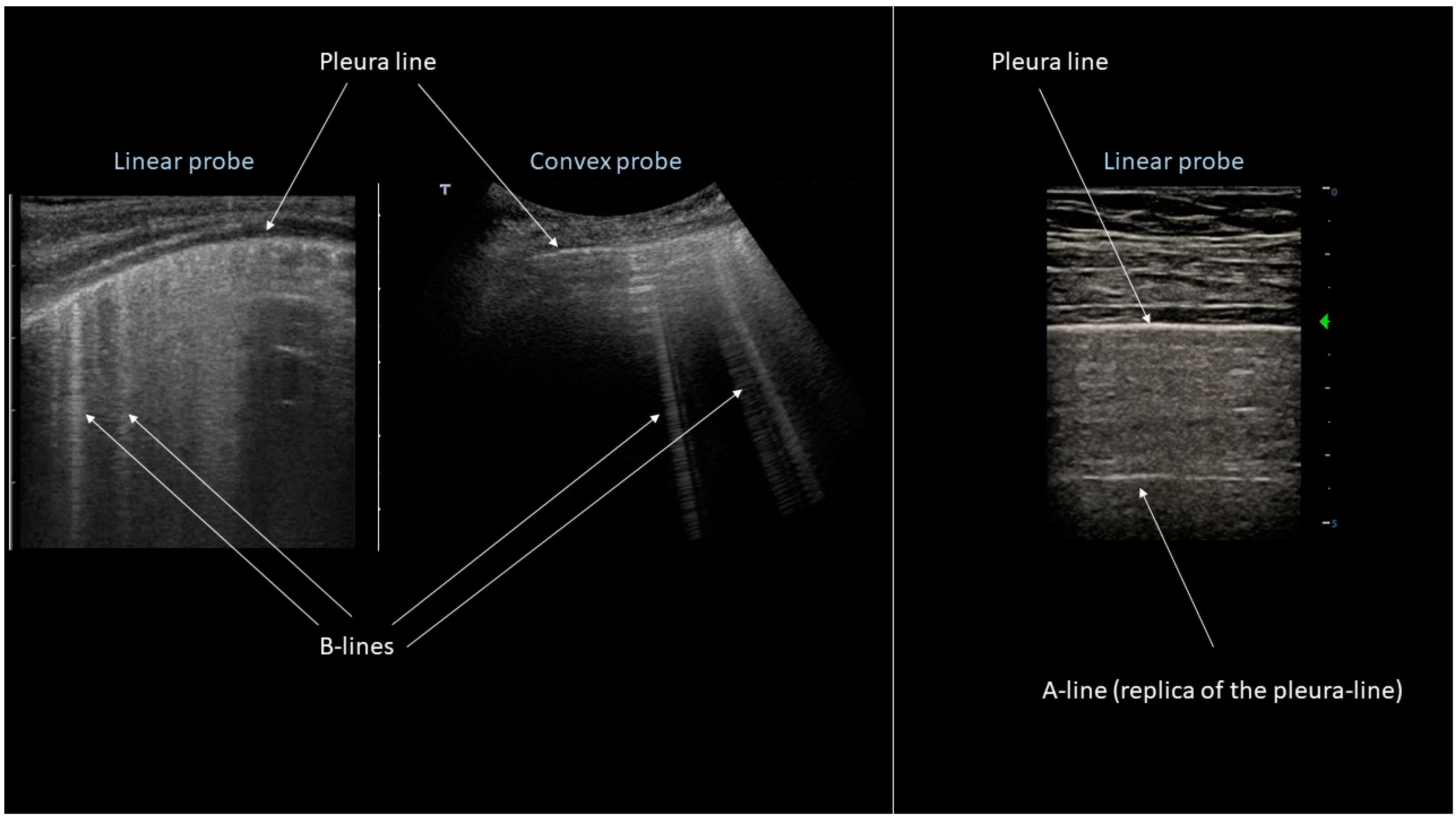 Applied Sciences Free FullText Lung Ultrasound Imaging, a