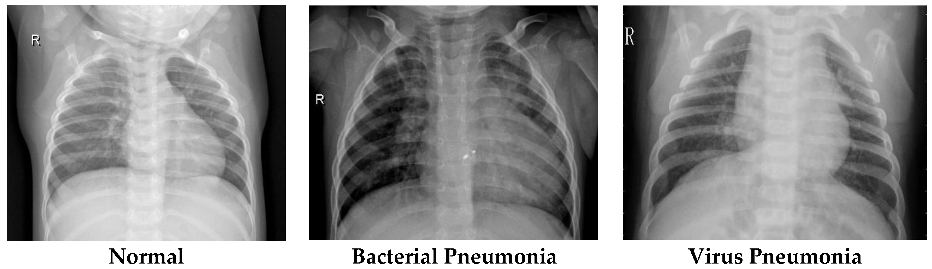 Applied Sciences Free Full Text A Novel Transfer Learning Based Approach For Pneumonia Detection In Chest X Ray Images Html