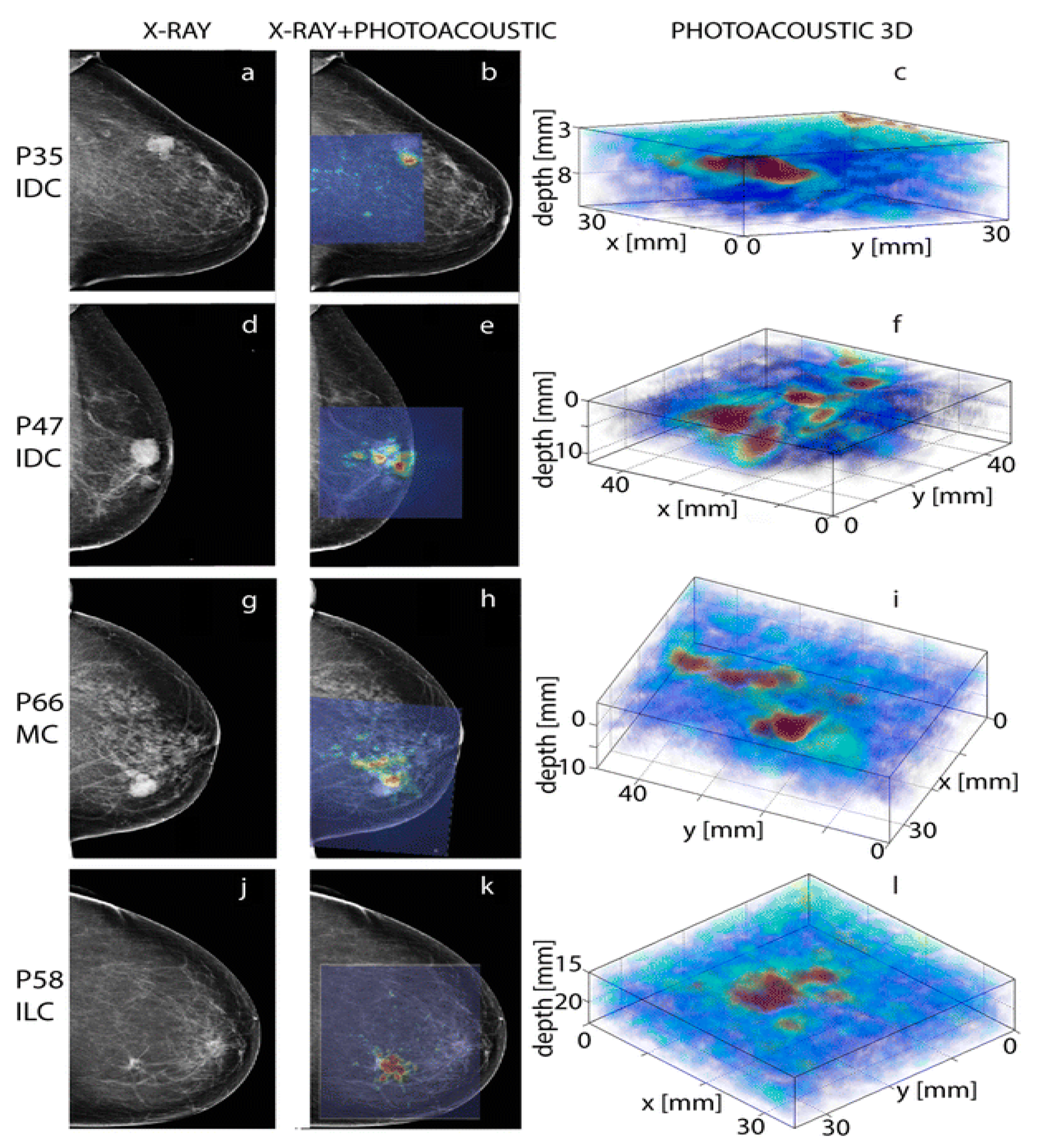 breast cancer imaging thesis