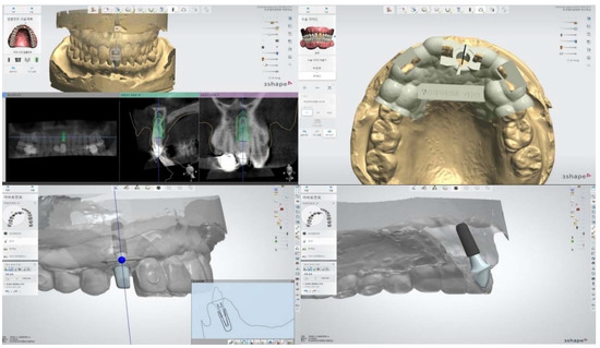 Soft Tissue Evaluation of an Immediate Esthetic Zone Single Implant ...
