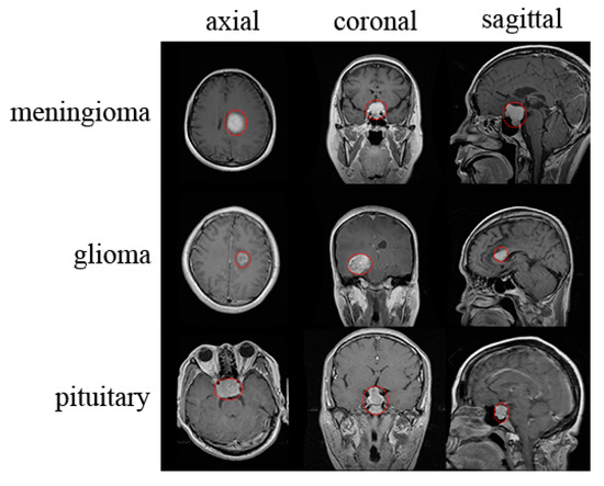 Applied Sciences | Free Full-Text | Classification of Brain Tumors from ...