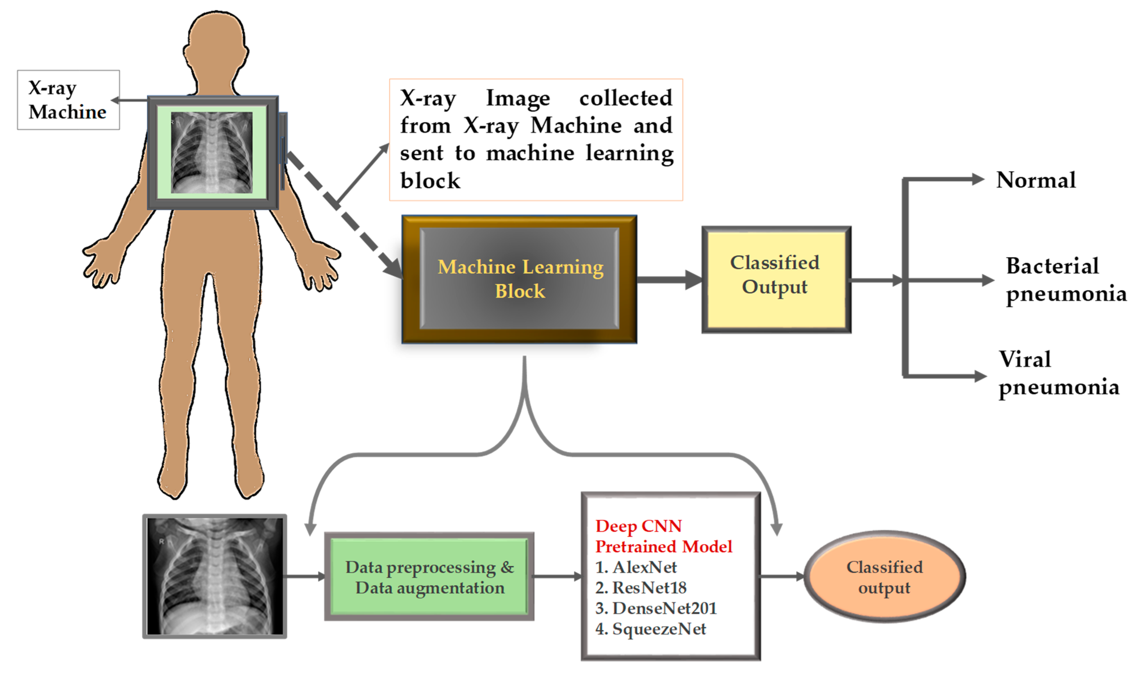 case study on pneumonia