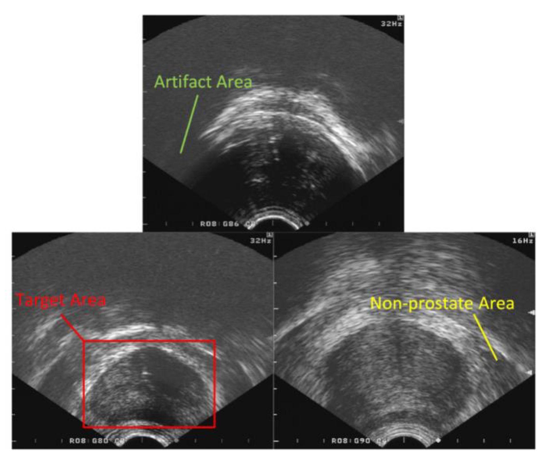 prostate imaging ultrasound excreția în prostatita