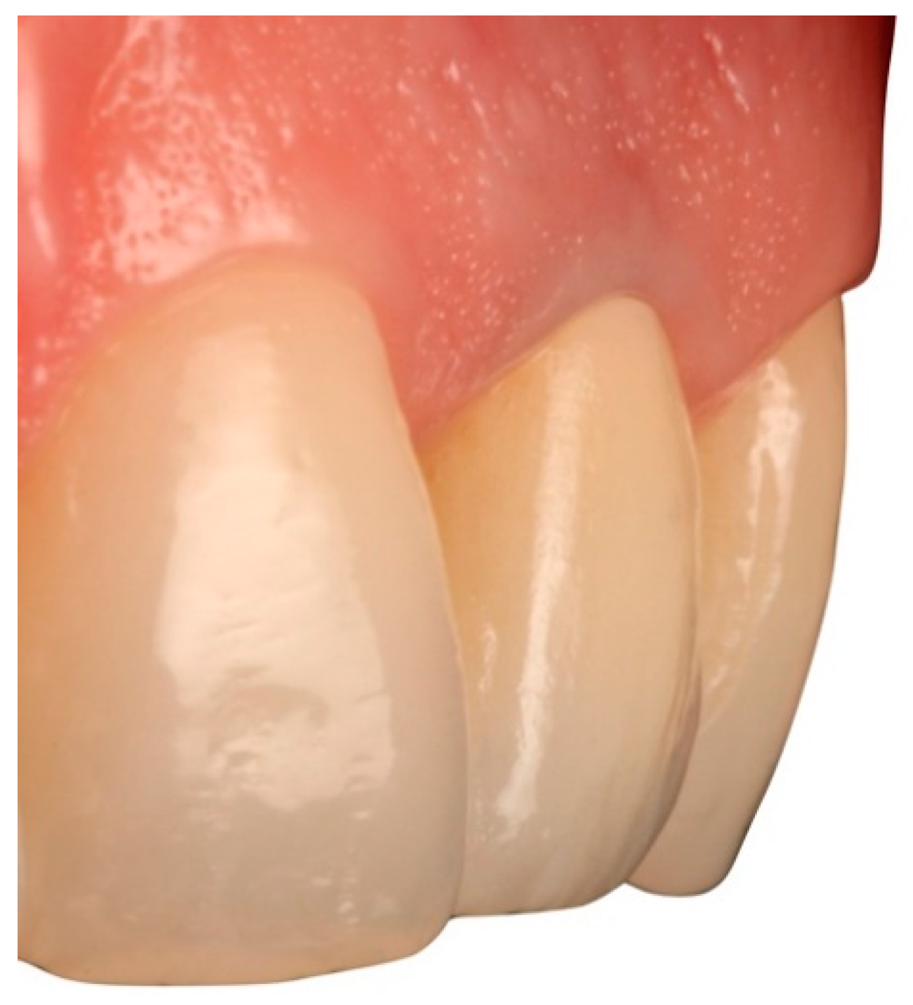 Influence of Angulation in Cervical Prosthetic Emergences