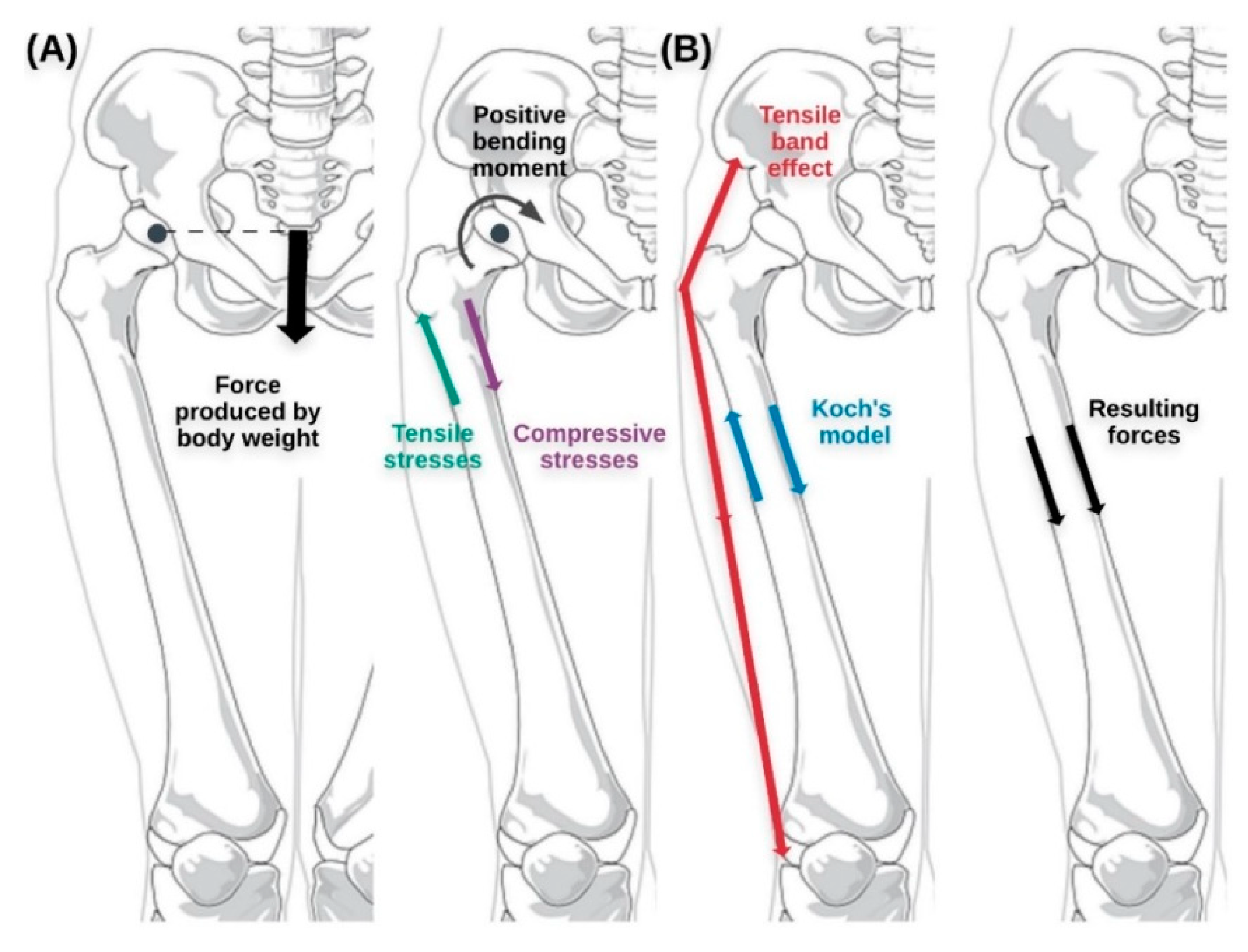 Applied Sciences Free Full Text Biomechanical Study Of Proximal Femur For Designing Stems For Total Hip Replacement Html