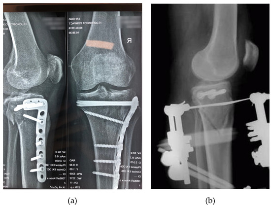 Ilizarov Surgery - Golden State Orthopedics & Spine