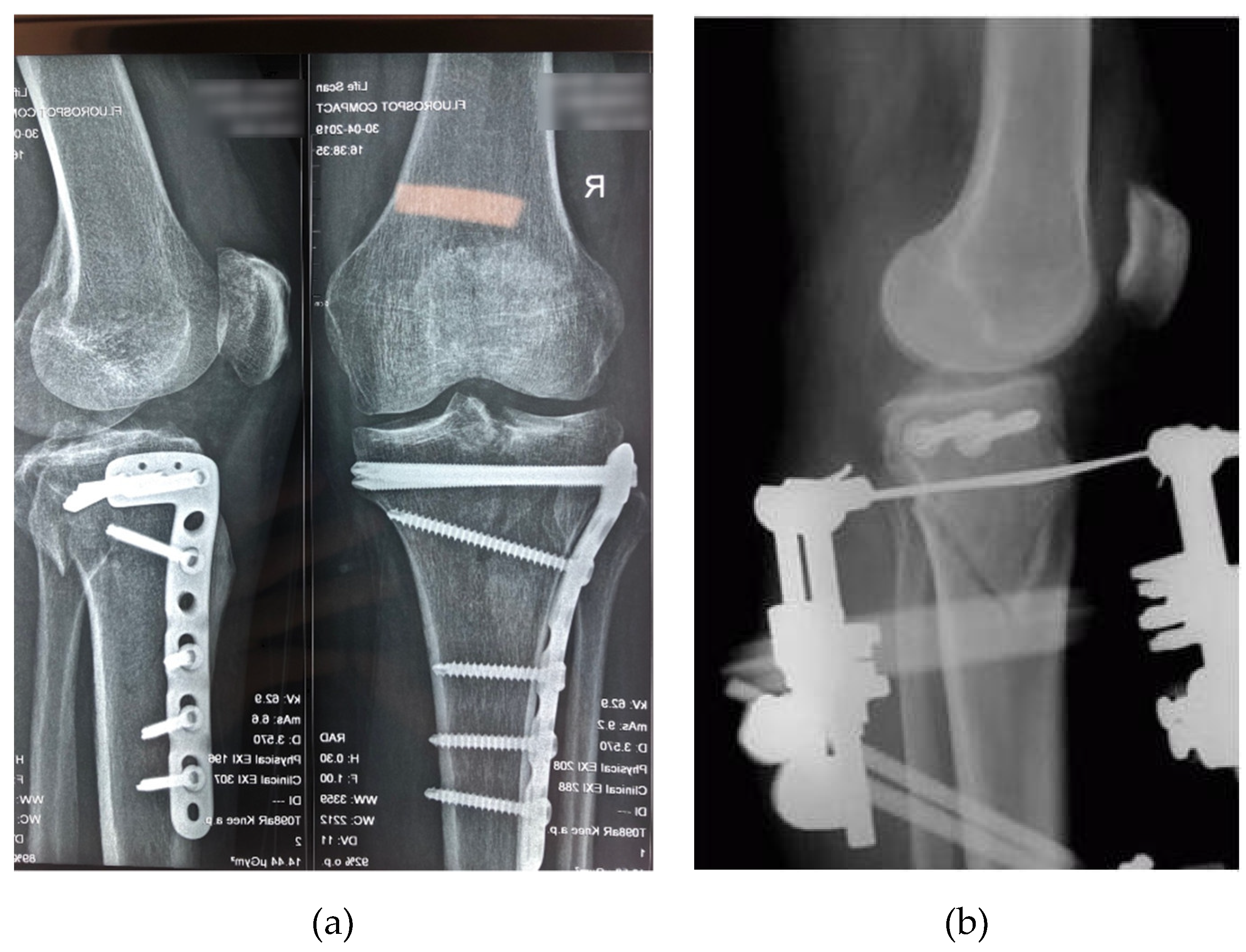 TIBIA BY HYBRID FIXATION