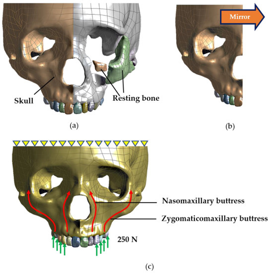 Tripod Fracture Repair