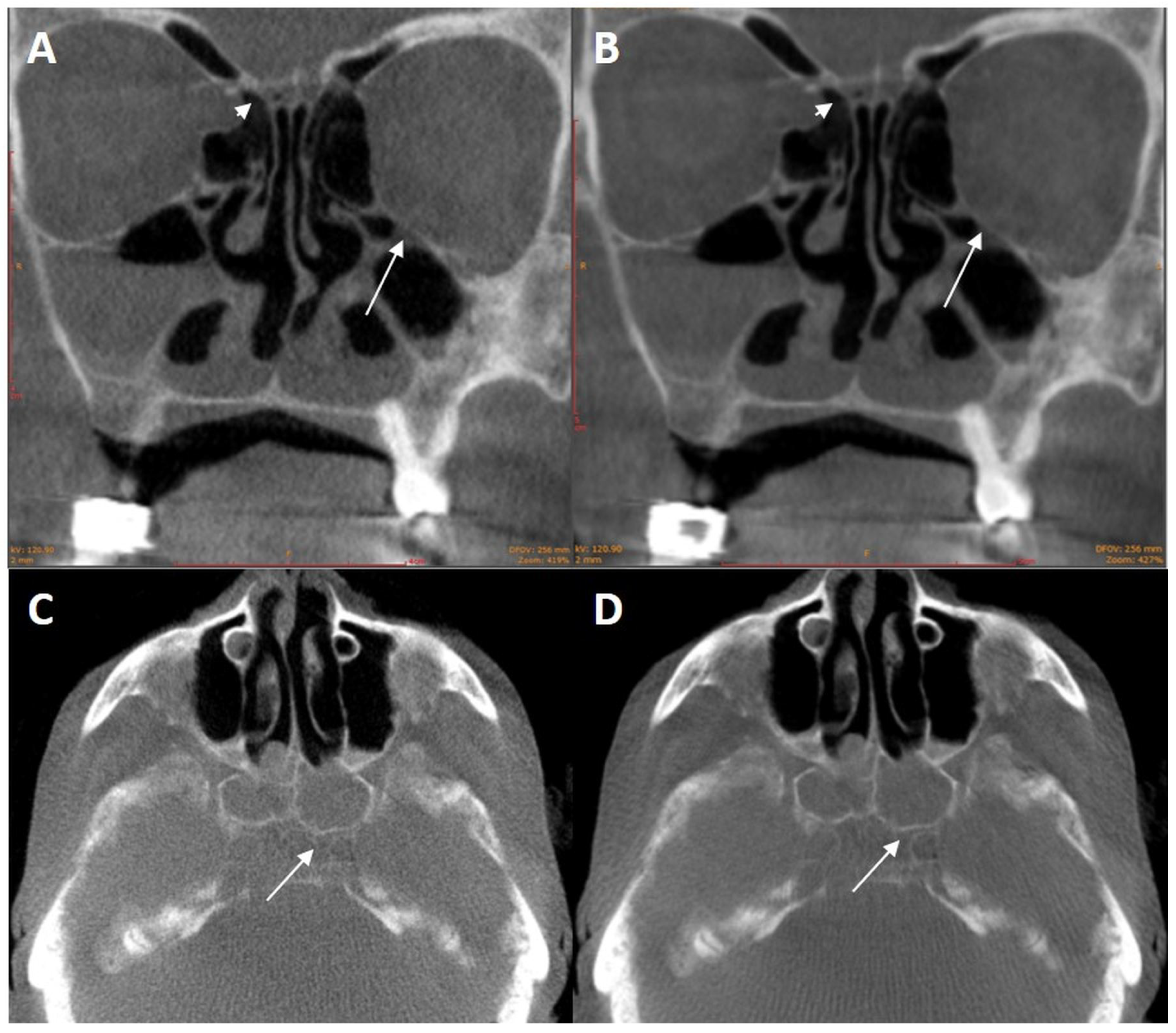 Applied Sciences Free Full Text Cone Beam Ct Imaging Of The Paranasal Region With A Multipurpose X Ray System Image Quality And Radiation Exposure Html Applied Sciences Free Full Text Cone Beam Ct Imaging Of The Paranasal Region With A Multipurpose X Ray System Image Quality And Radiation Exposure Html