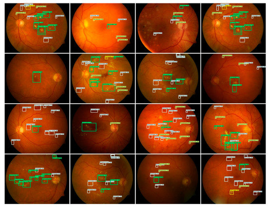 Applied Sciences | Free Full-Text | Retinal Image Analysis for Diabetes ...