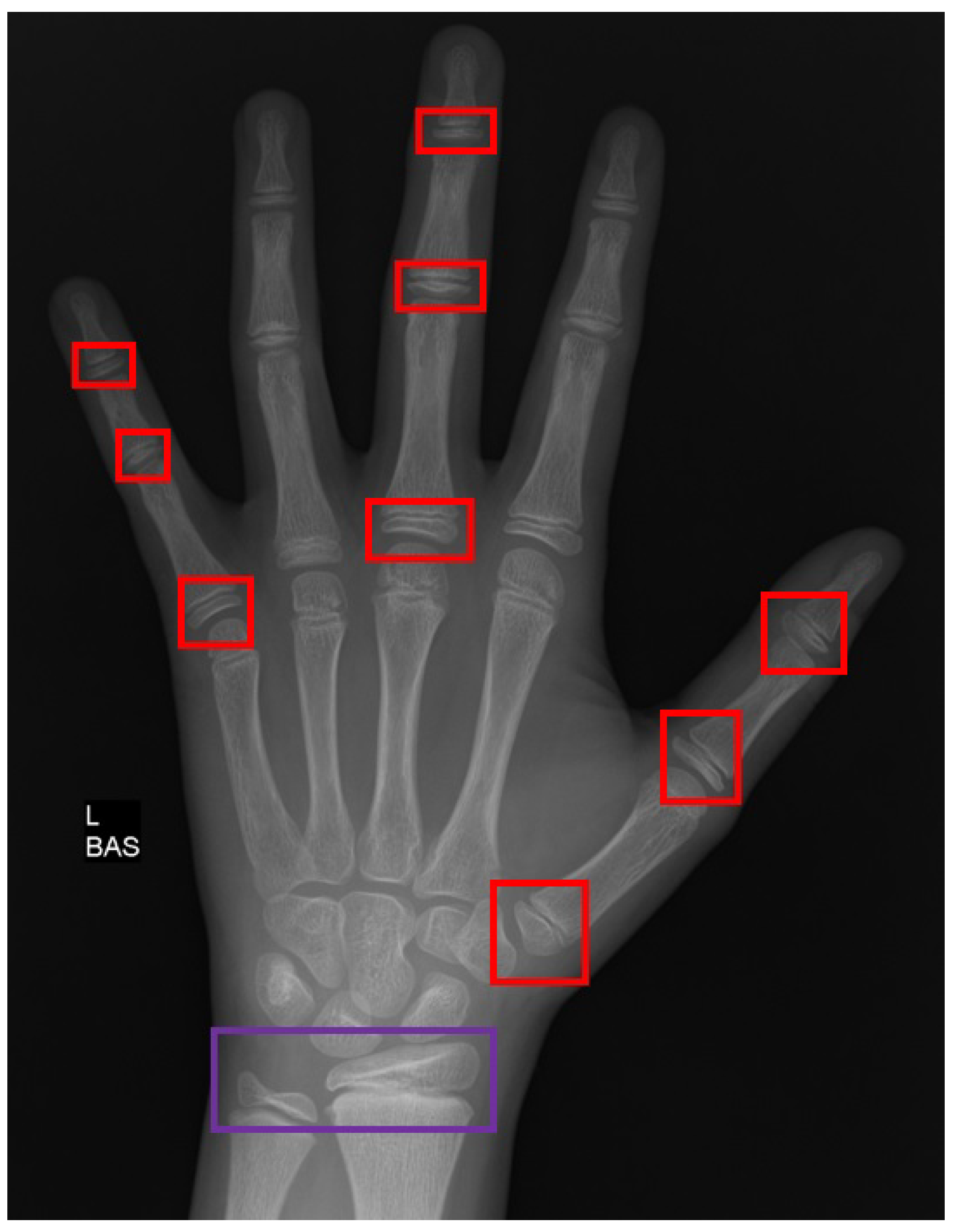 bone age less than chronological age bone age less than chronological age