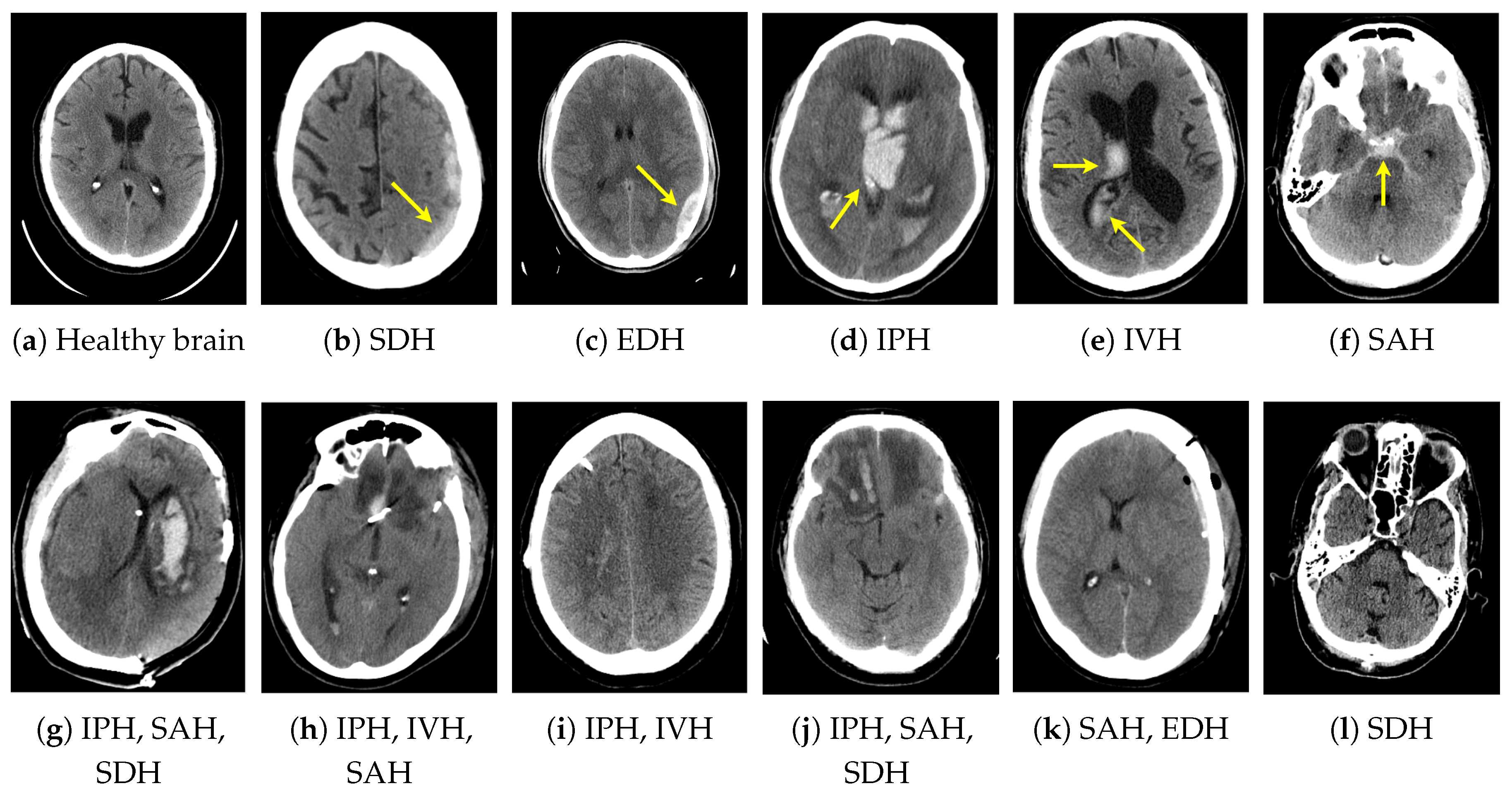 Applied Sciences Free FullText Intracranial Hemorrhage Detection