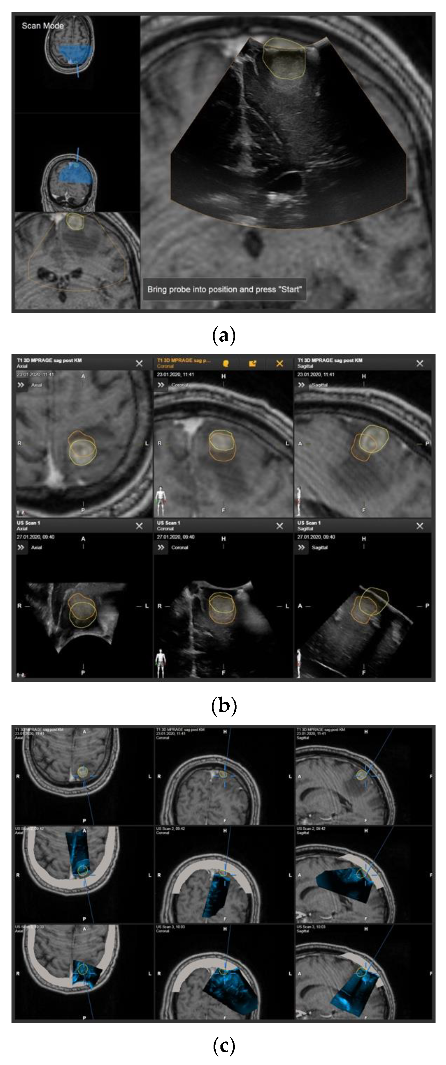 Navigated 3D Ultrasound in Brain Metastasis Surgery: Analyzing the 