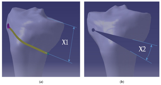 Medial Opening Wedge High Tibial Osteotomy in Knee