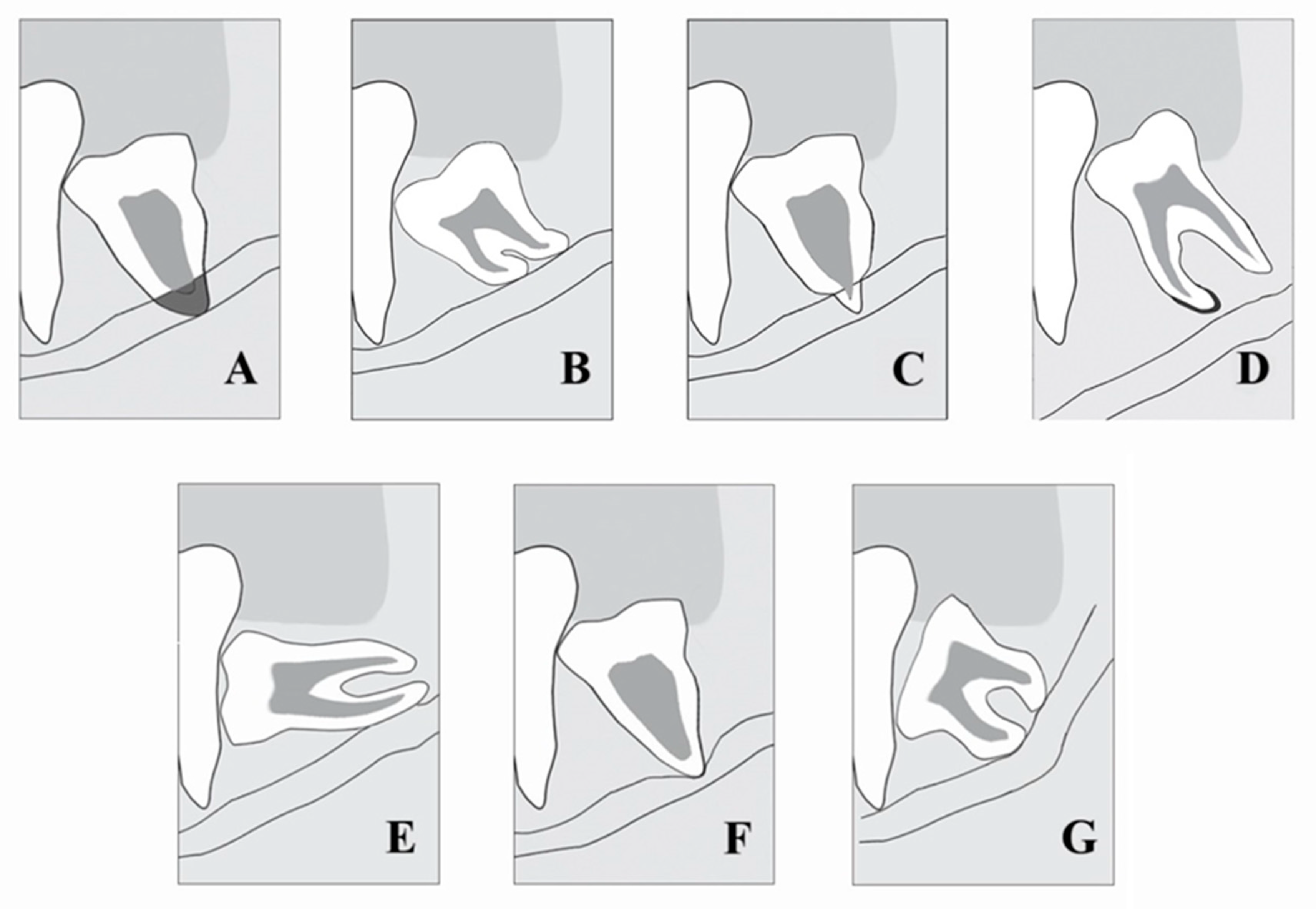 Treatment of horizontal impaction of left mandibu - 굿스마일포럼