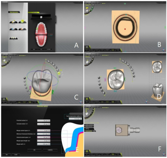 Marginal and Internal Fit of Ceramic Prostheses Fabricated from ...