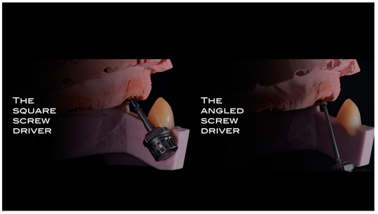 Angled Screwdriver Solutions and Low-Profile Attachments in Full Arch ...