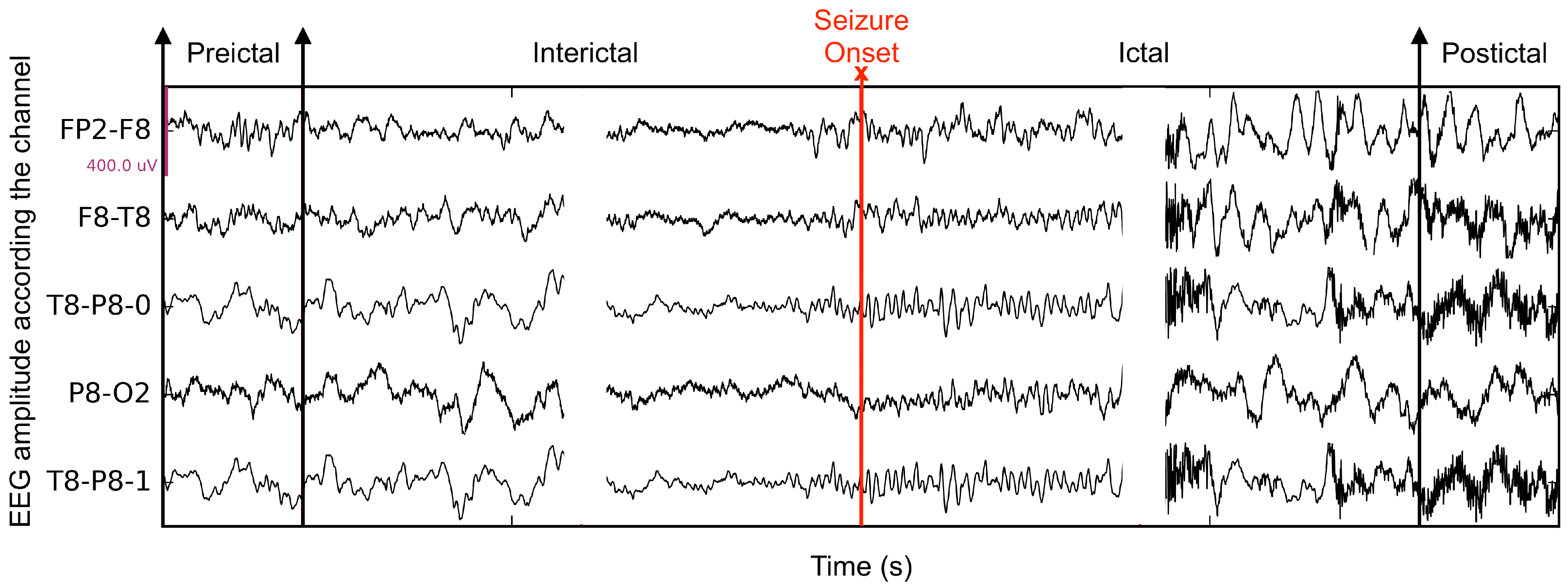 Seizure Phases