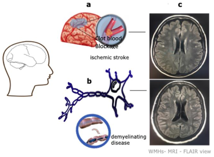 Neuroimaging and deep learning for brain stroke detection - A review of  recent advancements and future prospects - ScienceDirect