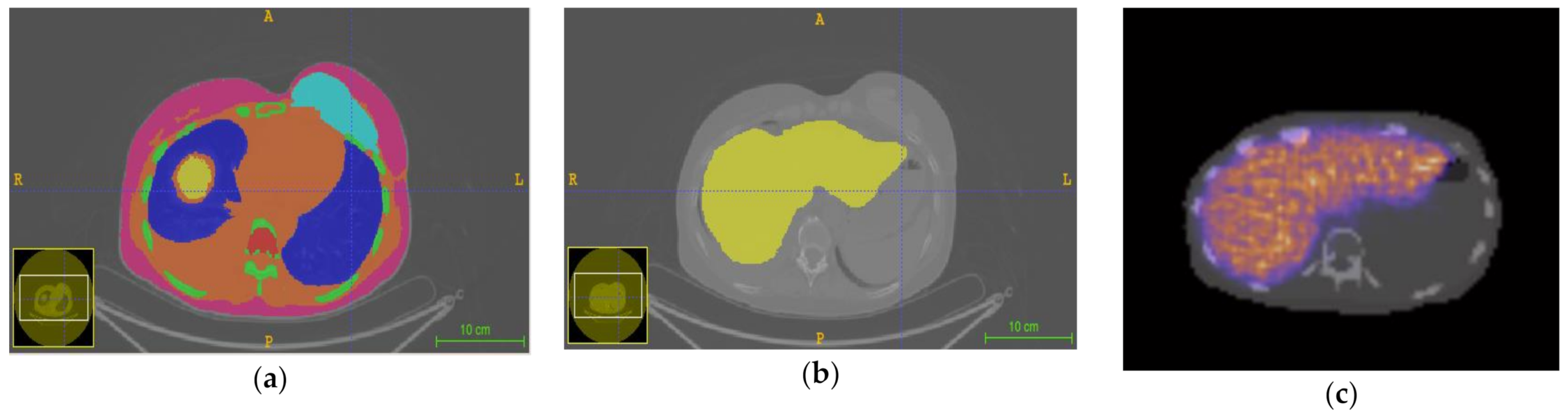 Applied Sciences | Free Full-Text | In Silico Validation of MCID Platform for Monte Carlo-Based Voxel Dosimetry to 90Y-Radioembolization of Liver Malignancies | HTML