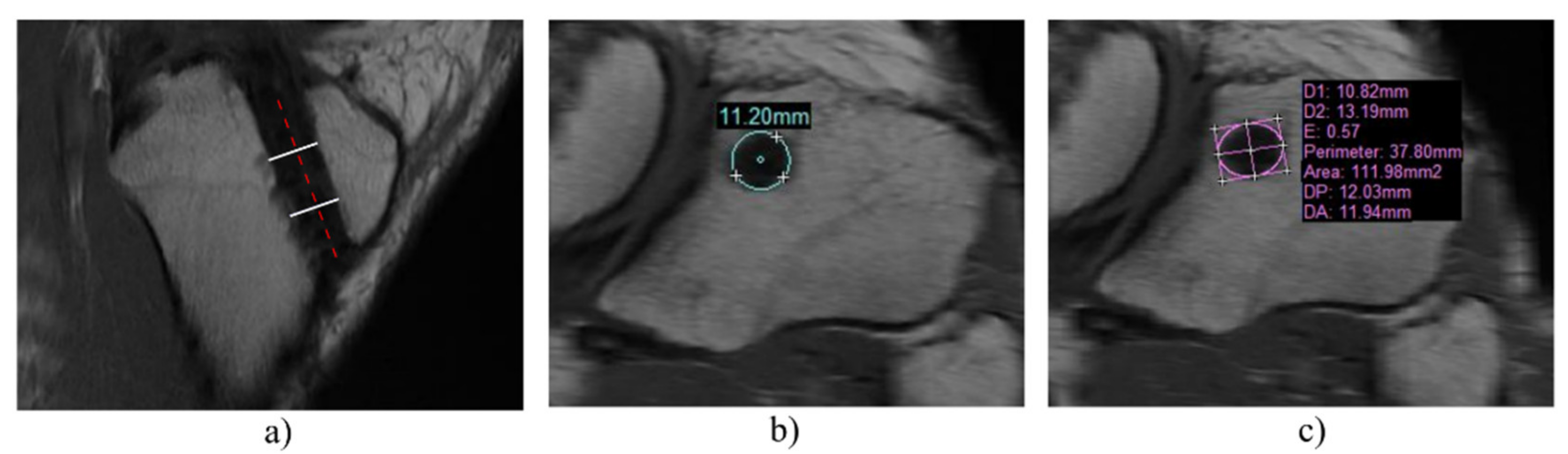 Applied Sciences Free Full Text The Influence Of Bone Bruises On Bone Tunnel Enlargement Regarding Acl Rupture Html