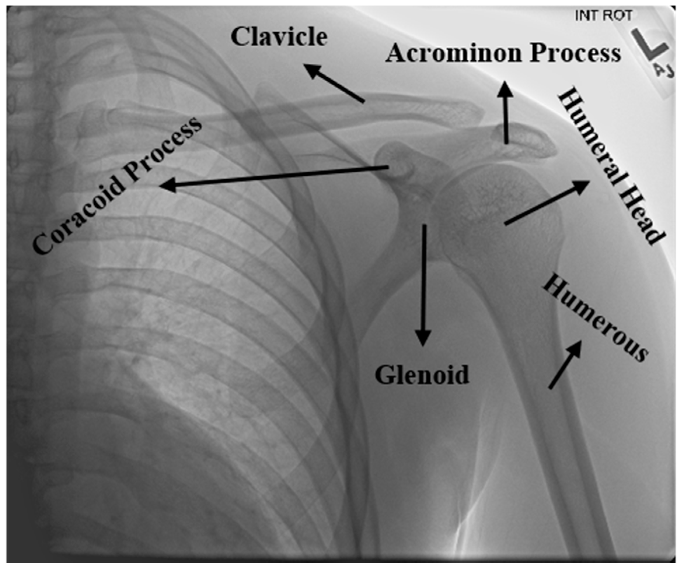 Shoulder Joint X Ray