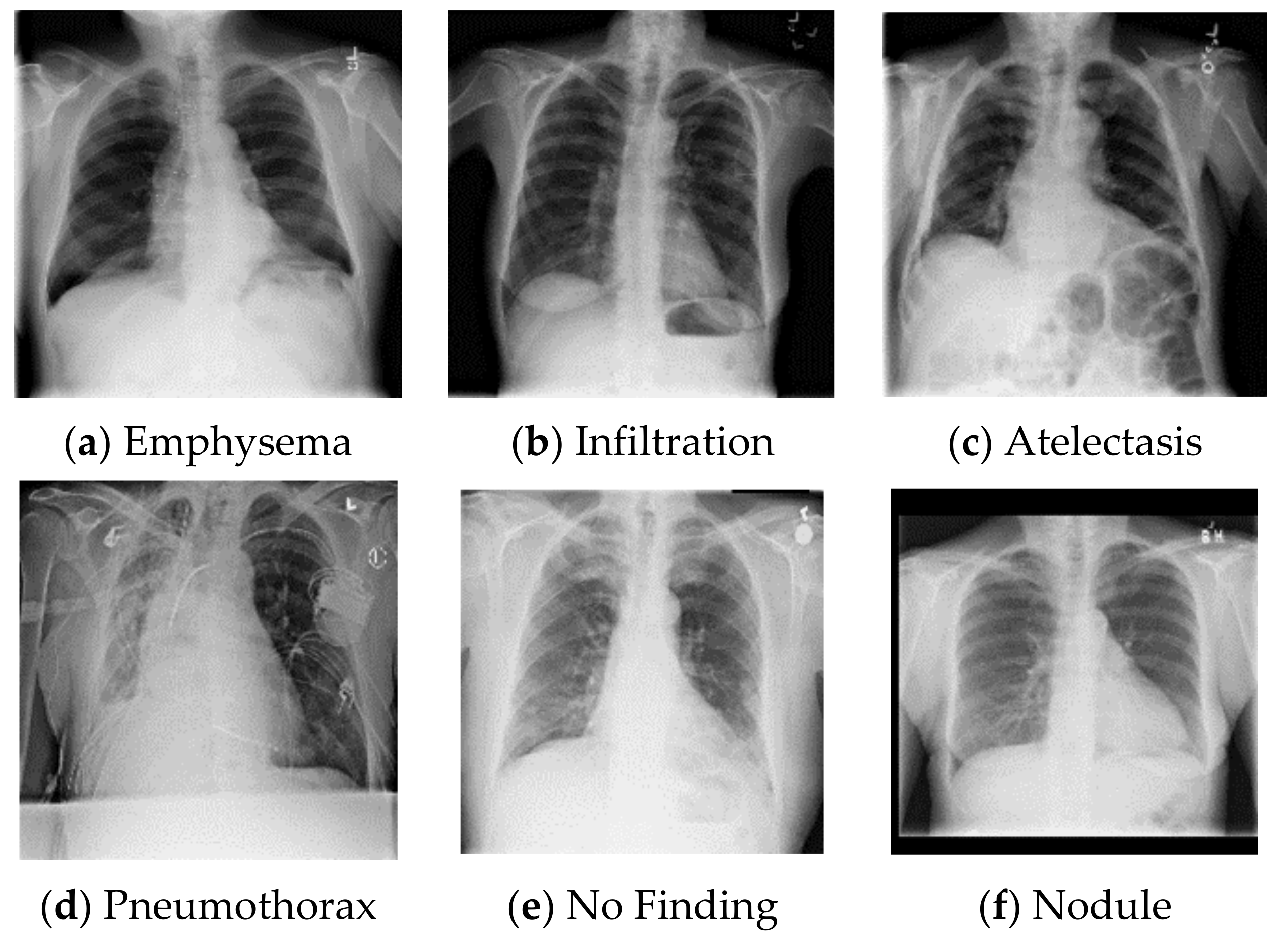 Chest X Ray Bronchitis Vs Pneumonia